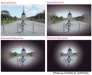 glaukoma-sights-vision